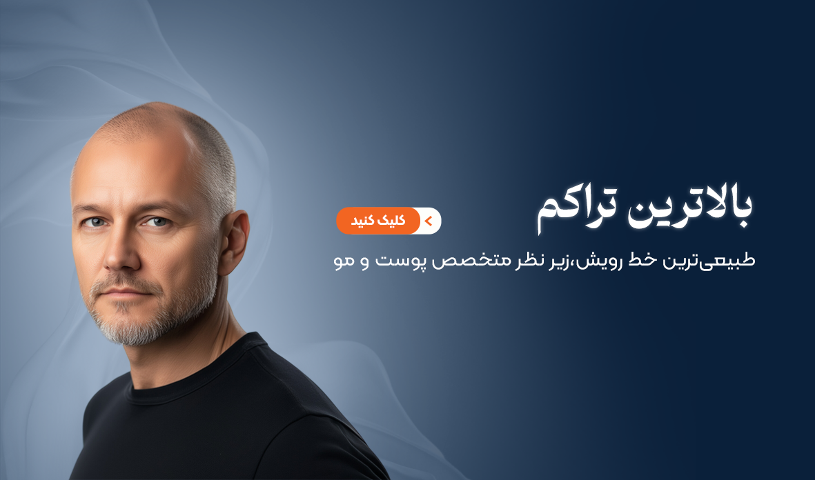 کاشت مو سیما ابراهیمی