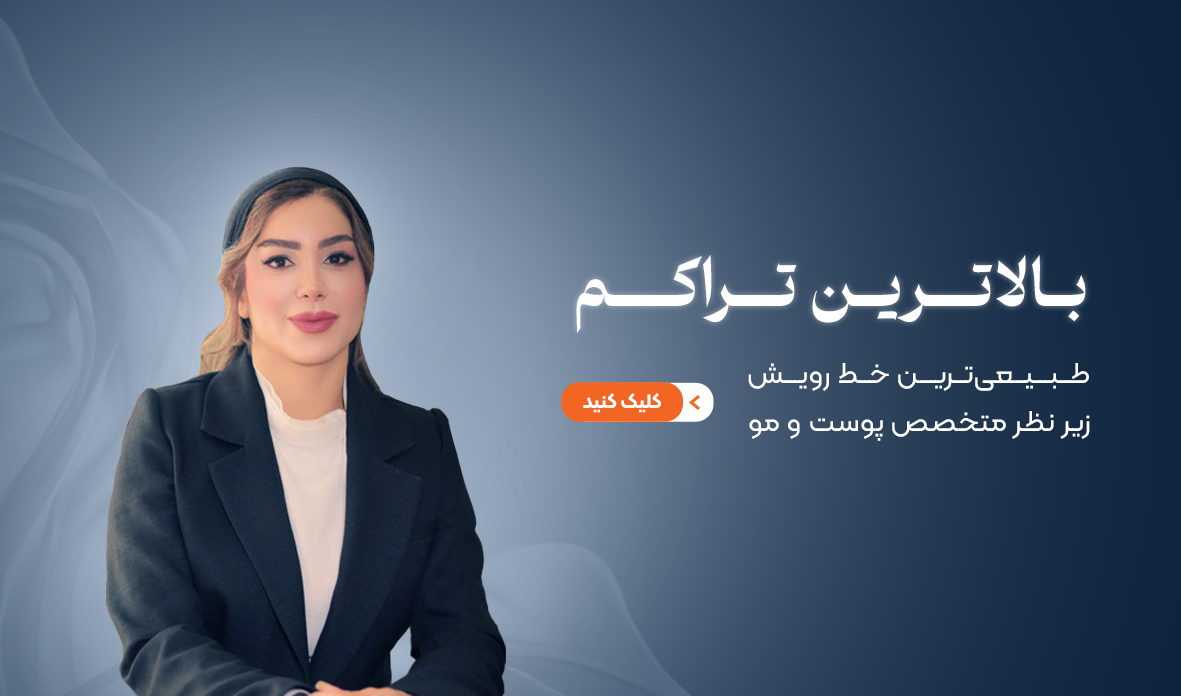 کاشت مو سیما ابراهیمی