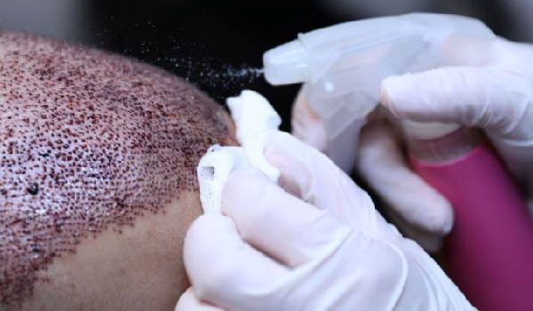 علائم عفونت بعد از کاشت مو و روش درمان عفونت بعد از کاشت