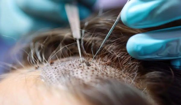 شرایط مناسب کاشت مو برای افراد. جدول مقایسه ای 