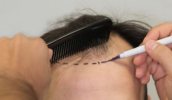 کاشت مو در زمان ریزش مو: آیا این تصمیم درست است؟