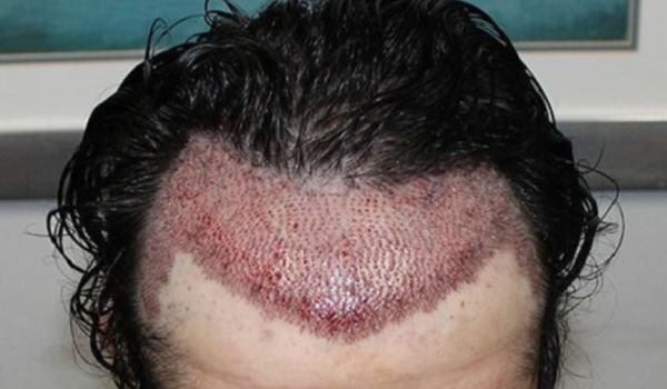 علت کبودی سر بعد از کاشت مو چیست؟ راهکارهای قطعی درمان