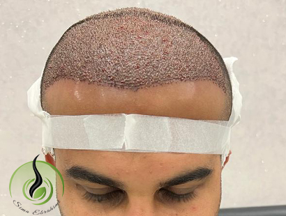 hair-transplant