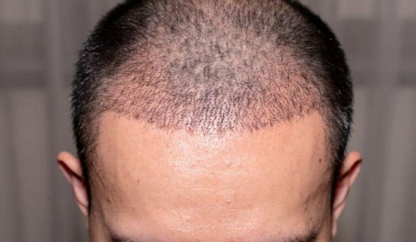 ممنوعیت های پس از کاشت؛ 20 مورد از نباید های پس از کاشت مو