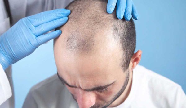 بررسی دلایل ریزش مو بعد از کاشت مو با مدت زمان و راهکار واقعی