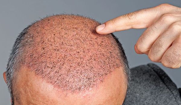 بهترین زمان برای کاشت مو