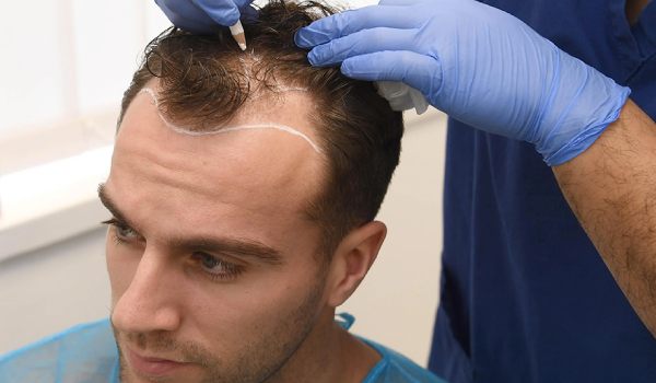 بهترین روش کاشت مو در شیراز