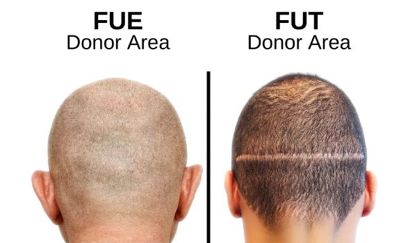 مقایسه FUT و FUE