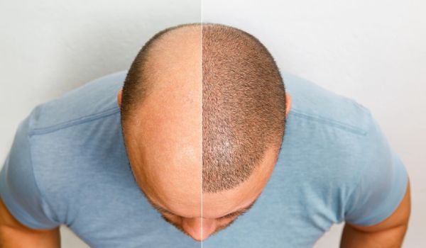 تاثیر الگوی ریزش مو بر موفقیت کاشت مو