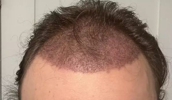 علت کبودی سر بعد از کاشت مو