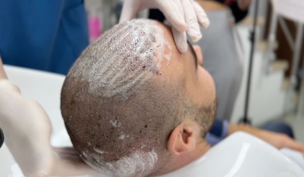 نحوه شست و شوی سر پس از کاشت