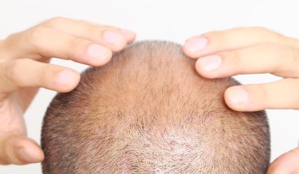 شوک ریزش مو بعد از کاشت