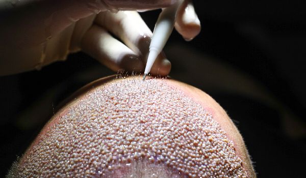 دلیل ریزش مو بعد از کاشت چیست
